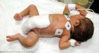 pakistan - 6 Bacaklı Bebek Ameliyat Edildi
