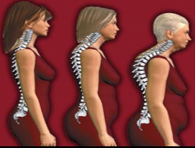 Yaşlılıkta osteoporoz tehlikesine dikkat!