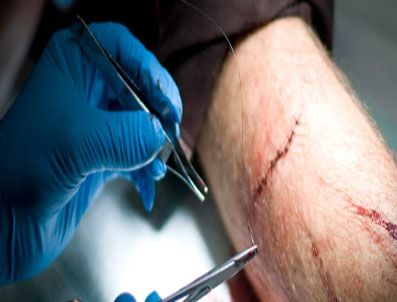 DAILY MAIL - Kopuk kolunu 3 ay bacağında taşıdı!