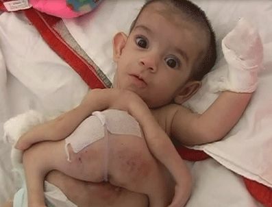 Görenleri hayrete düşüren İlknur karnında ikiziyle yaşıyor