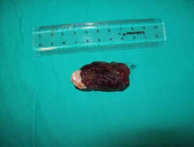 TUMOR - Kalbinden Yumurta Büyüklüğünde Tümör Çıktı