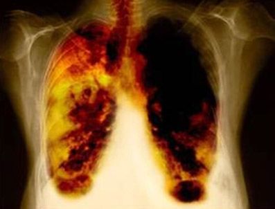 Akciğer kanserinin tedavisi bulundu