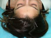 Uyku Apnesi Hastalarına Müjde