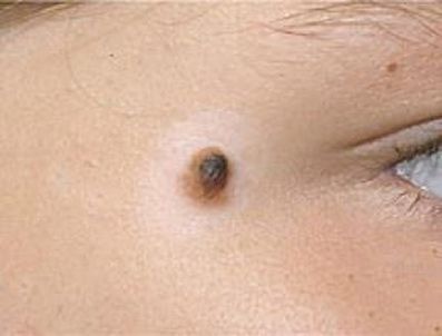 BENIN - Benleri aldırmak zararlı mıdır?