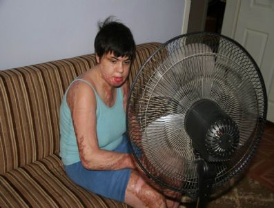 ULUDAĞ ÜNIVERSITESI TıP FAKÜLTESI HASTANESI - Herkes Sıcaktan Yanarken O Güneşi Özlüyor