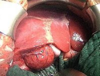 Karaciğer nakline ihtiyaç var!