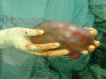 Hamile Kadının Karnından 1,5 Kiloluk Kitle Çıktı