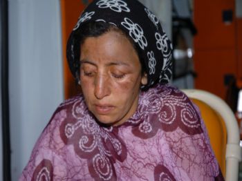 Çadır Yangınında Yaralanan Anne İle Kızı Diyarbakır'a Sevk Edildi