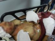 Çivilerle güçlendirilmiş bomba elini kopardı