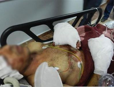 Çivilerle güçlendirilmiş bomba elini kopardı