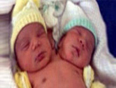 Brezilya da iki başlı bebek dogdu
