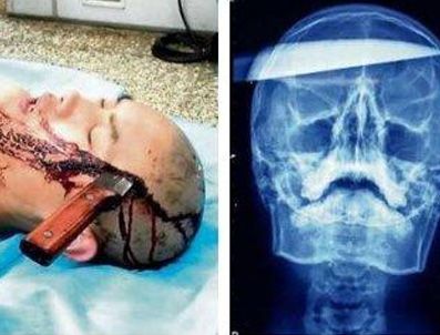 COUNTER STRIKE - Kafatasında 15 cm'lik bıçak çıktı