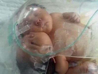 Çin'de İki Başlı Kız Bebek Doğdu