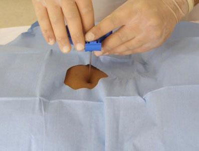 Biyopsi işleminde hastalar neden ölüyor?