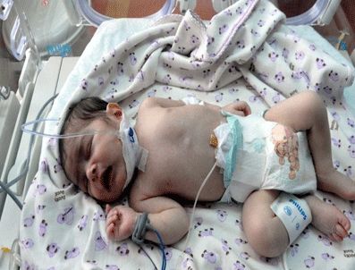 BÜLENT ORAN - 10 günlük bebeğe stent takıldı