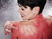 Güneş yanıklarındaki acının kaynağı bulundu