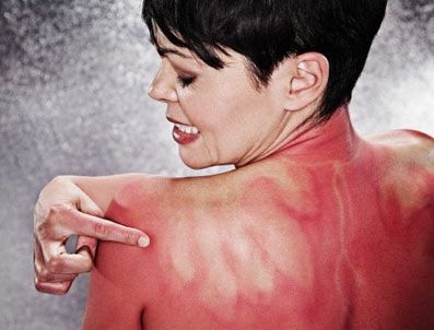 Güneş yanıklarındaki acının kaynağı bulundu