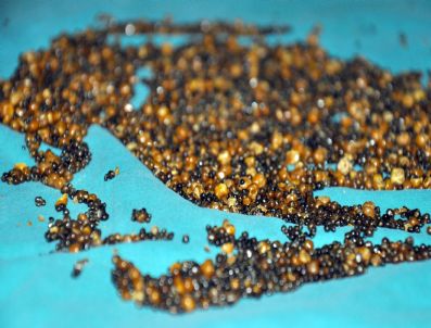 Hastanın Safra Kesesinden 8 Bin 422 Taş Çıktı