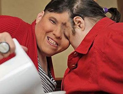 İşte dünyanın en yaşlı yapışık ikizleri