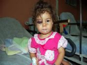 Küçük Kız Merdivenden Düştü