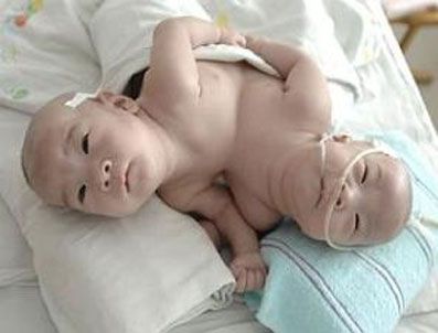 Çin'deki siyam ikizleri ameliyatla ayrıldı