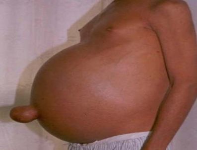 Siroza Bitkisel Tedavi Önerisi