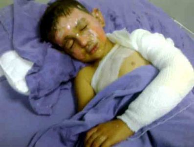 Terör Örgütü Yandaşlarının Yaktığı 6 Yaşındaki Sedat’ın Tedavisi Sürüyor