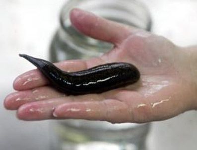 Boğazındaki sülükle bir hafta yaşadı