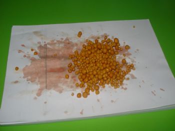 İdrar Torbasından 500 Taş Çıktı