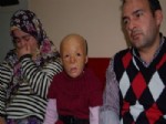 YÜZ NAKLI - Türkiye'nin İlk Yüz Nakli Küçük Buse'yi Umutlandırdı