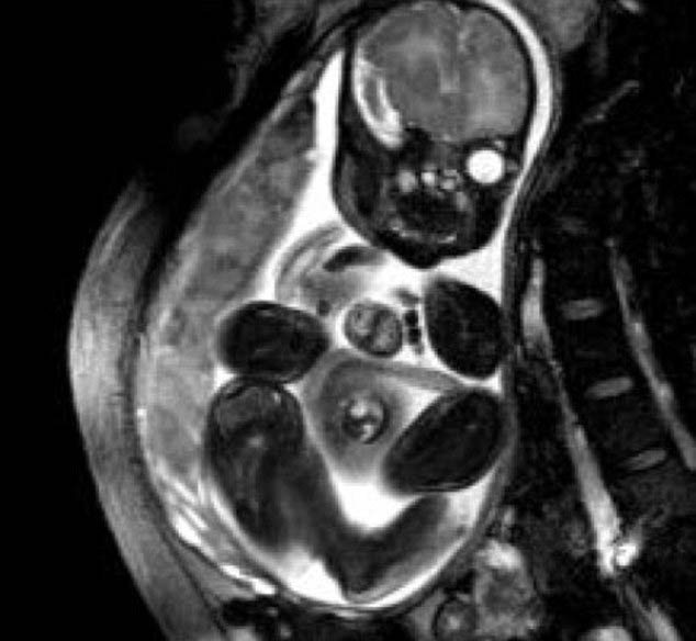 Mucize Bebeğin Ameliyatı Başarılı Geçti