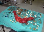 PARANOYA - İskenderun’da Şizofren Hastasının Bağırsaklarından Bıçak Çıktı