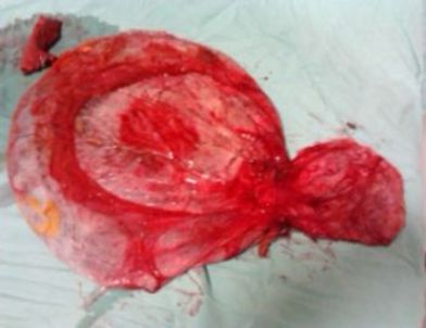 Karnındaki Kitleden Kurtulan Kadın, 3 Günde 20 Kilo Verdi