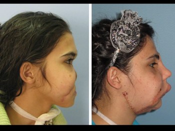 İşte 3. yüz naklinden ilk görüntüler