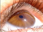 ROMATOID ARTRIT - Göz Renginiz Cilt Hastalığının Habercisi Olabilir