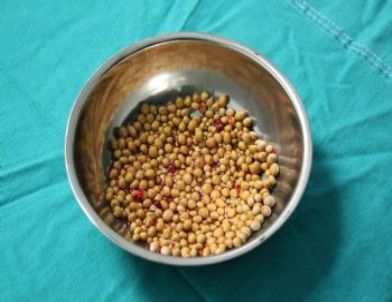 Hastanın Mesanesinden 600’den Fazla Taş Çıkarıldı