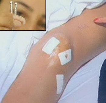 Asena'nın Dizinden İki Çivi Çıkartıldı