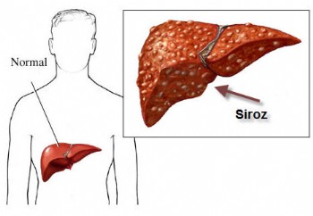 Siroz Hastası Bağışlanan Karaciğer İle Sağlığına Kavuştu