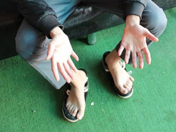 El ve ayaklarında 6 parmak var