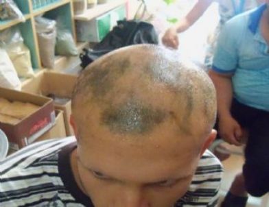 13 Yıl Sonra Saçlarının Çıkmasının Mutluluğunu Yaşadı