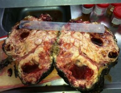 5 Kiloluk Tümör Doktorları Şaşırttı