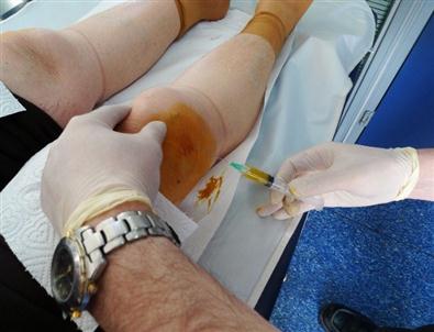 Diz Kireçlenmesinde Yeni Umut Açıklaması