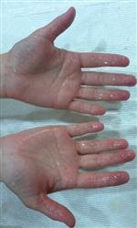 Aşırı Terleme Hastalığı