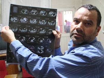 13 yıl belinde unutulan ameliyat makasıyla gezdi