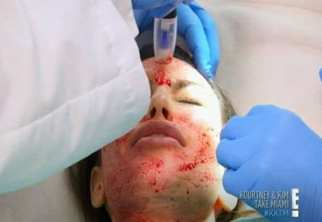 Kim Kardashian Kendi Kanıyla Gençleşti!