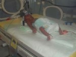12 Gün Önce Dünyaya Gelen 560 Gramlık Parmak Bebek Hayata Tutundu