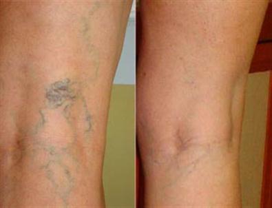 Varislere Lazer ve Köpük Tedavisi