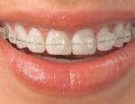 ÇENE KEMİĞİ - Ortodonti için geç değil