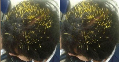 Kadın Kirpinin Hayatını Böyle Kurtardı