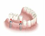 İMPLANT TEDAVİSİ - Eksik Dişler İçin Yeni Tedavi Yöntemi